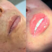 Botox Labial Uberlândia Antes e Depois