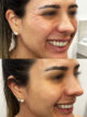 Botox Uberlândia