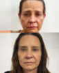 Harmonização Facial Uberlândia