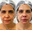 Harmonização Facial Uberlândia