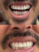 Restauração Dentária Antes e Depois